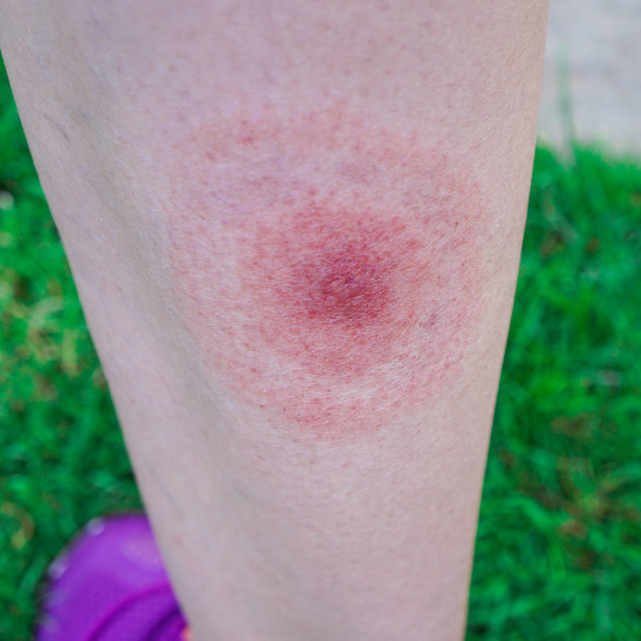 Picaduras de garrapatas, abejas y mosquitos: ¿cuándo hay que ir urgentemente al médico?